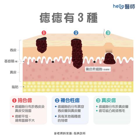 陰莖長黑痣|陰莖快速長出黑痣